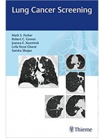 Lung Cancer Screening 1st Edition