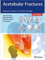 Acetabular Fractures