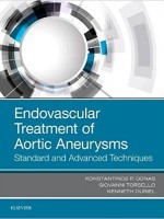 Endovascular Treatment of Aortic Aneurysms: Standard and Advanced Techniques, 1e 1st Edition