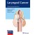 Laryngeal Cancer