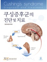 쿠싱증후군의 진단 및 치료