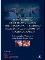 Robot Extended Nerve Sparing Radical Hysterectomy with Extended Pelvic Lymphadenectomy for the Cervi