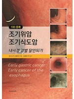 100 증례 조기위암 조기식도암-내시경 감별 달인되기