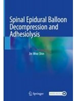 Spinal Epidural Balloon Decompression and Adhesiolysis