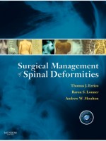 Surgical Management of Spinal Deformities