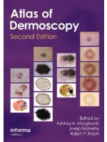 Atlas of Dermoscopy, 2/e