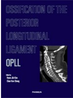 OPLL: Ossification of the Posterior Longitudinal Ligament