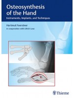 Osteosynthesis of the Hand Instruments, Implants, and Techniques