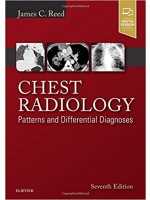 Chest Radiology: Patterns and Differential Diagnoses, 7e