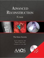Advanced Reconstruction:Knee