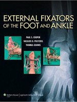 External Fixators of the Foot and Ankle