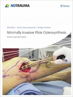 Minimally Invasive Plate Osteosynthesis (MIPO)