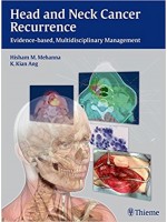 Head and Neck Cancer Recurrence
