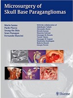 Microsurgery of Skull Base Paragangliomas