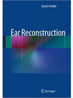 Ear Reconstruction